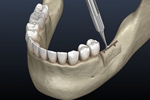 an illustration of ridge expansion surgery