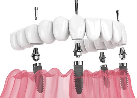 Illustration of All-on-4 dental implants against white background