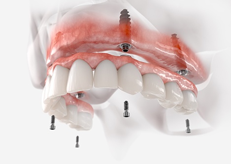 Illustration of fixed implant denture for upper arch