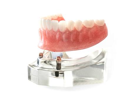 Model of implant denture for lower arch