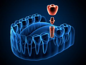 a closeup of a dental implant model