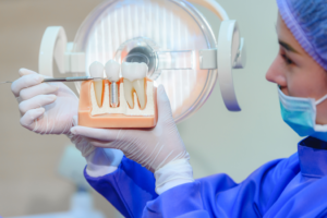 a model of a mouth with dental implants