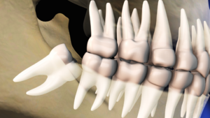 a 3D illustration of an impacted wisdom tooth